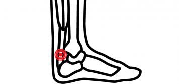 Achillessene inflammation
